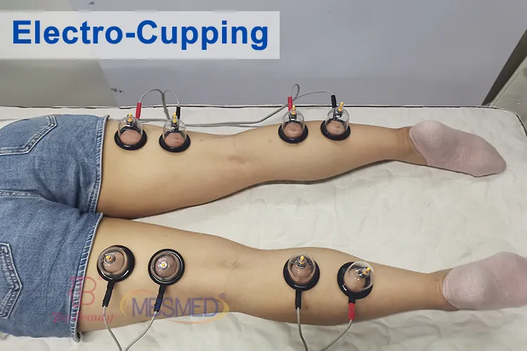 Cupping Therapy