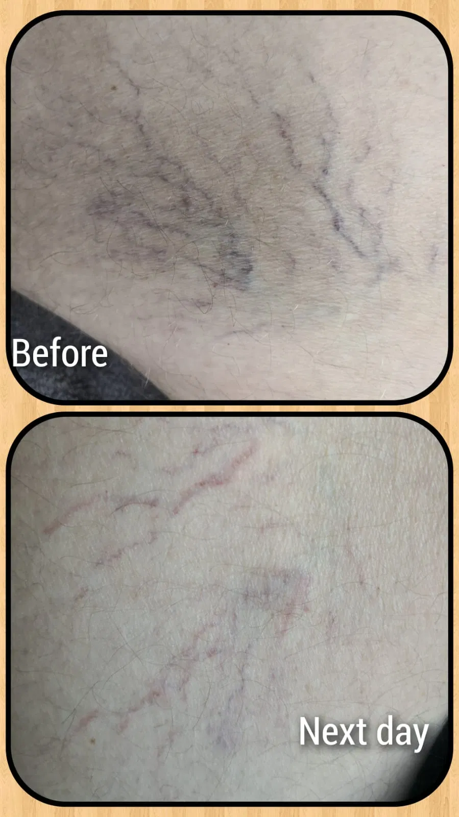 980nm Vascular Therapy