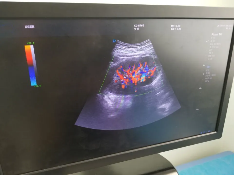 Ultrasound Device Side View