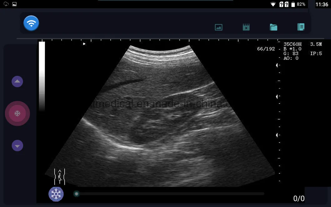 Wireless Ultrasound Scanner