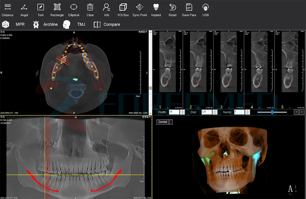 Neural Tube Marking