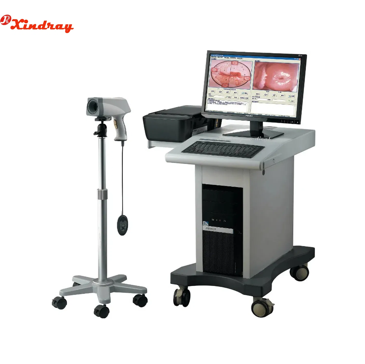 Digital Imaging System Video Colposcope