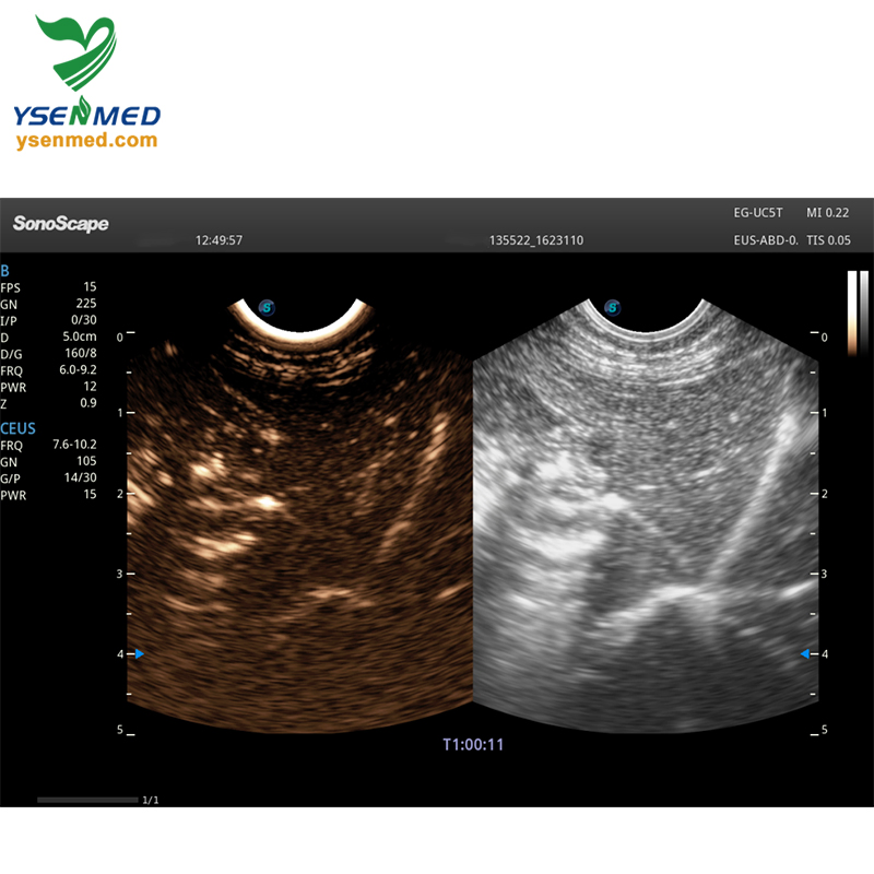Medical Equipment Sonoscape Eg-UC5t, Linear-Array Echoendoscope Video Endoscopy System