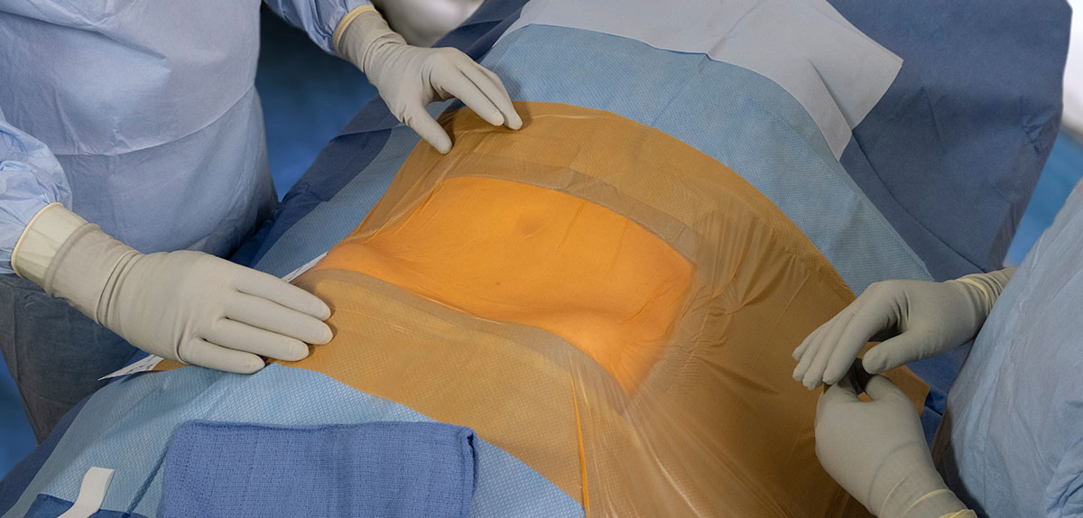 Customized Disposable Sterile Adhesive Transparent Surgical Film Incise Drape