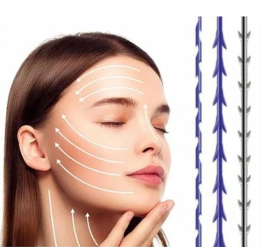 All Types of Korea Pdo Threads Hilos De Pdo Cog Face and Body Lift V Line Medical Suture Absorbable Suture Product