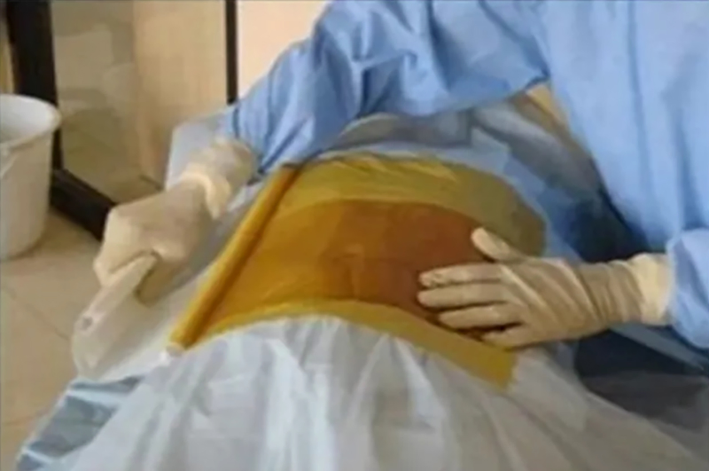 Iodine Impregnated Incision Drape with Transparent Film for Sterile Surgical Use