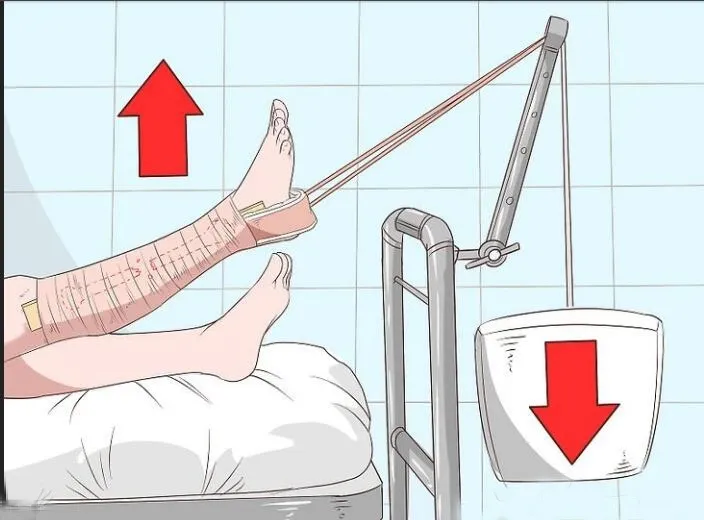 Application of Skin Traction Kit