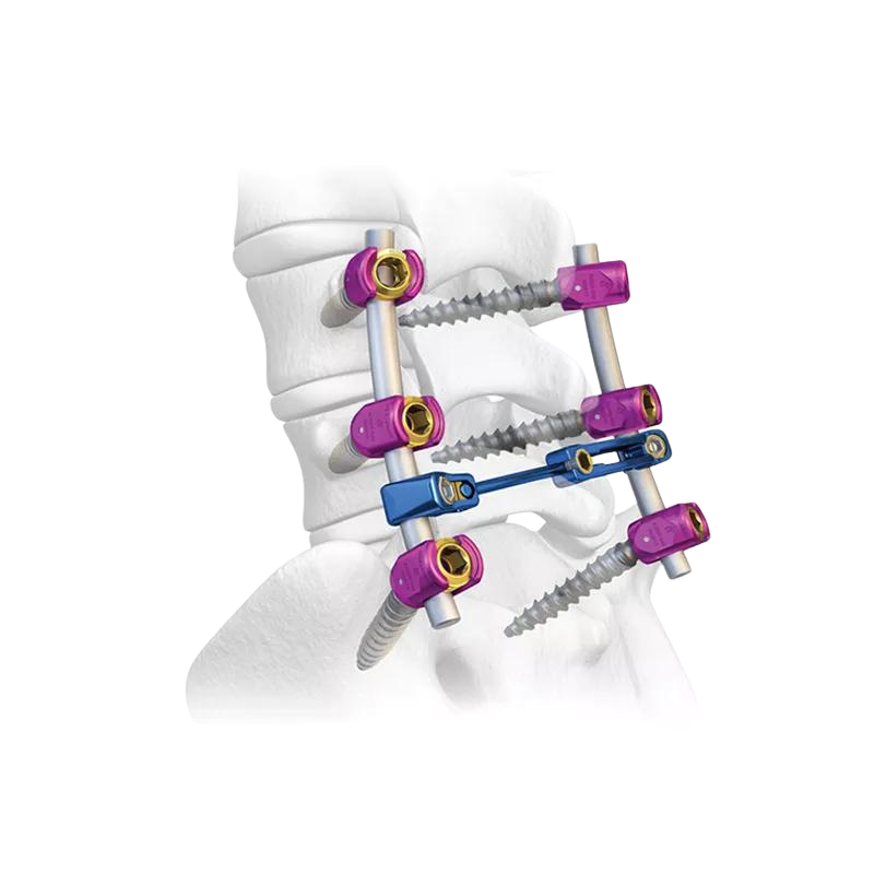 Factory Price 5.5mm Pedicle Screws Spinal Fixation System Titanium Orthopedic Spine Implants for Posterior Fixation
