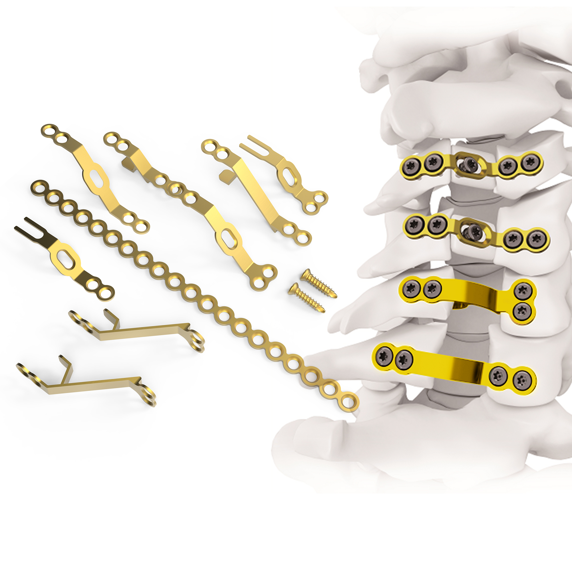 CANWELL Cervical Lamina Plate Titanium Cervical Laminoplasty Plate System Open Door Spine Implant with Screws Orthopedic CE ISO