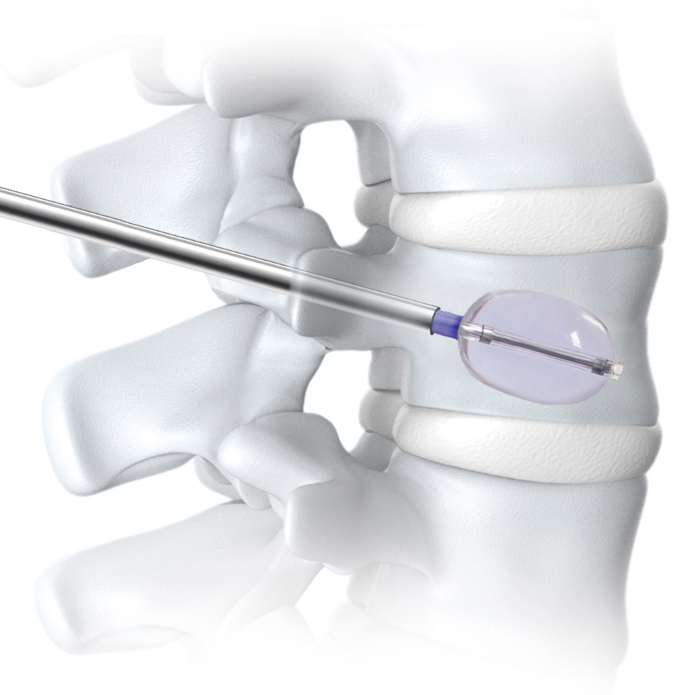 CANWELL PKP Percutaneous Kyphoplasty Balloon Curved Vertebral Perforator Kit Hospital Spine Cement Instrument Set