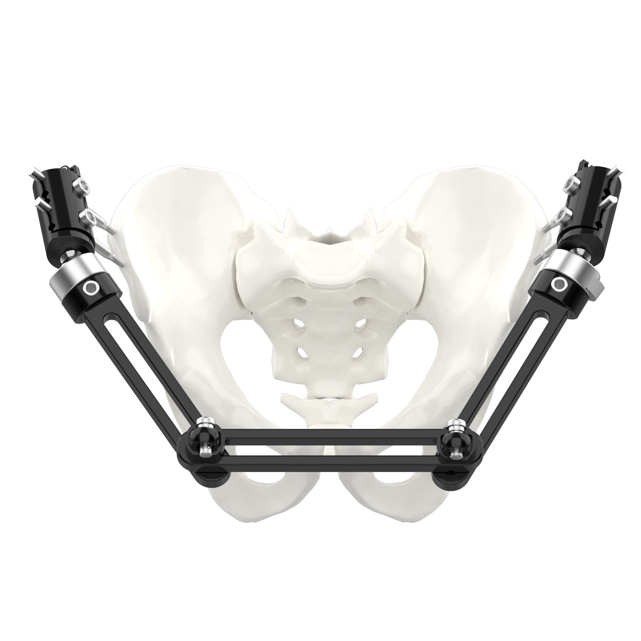 CANWELL Large External Fixation System Pelvic Frame Modular Construction Pelvic Ring Fractures Arthrodesis Osteotomies CE