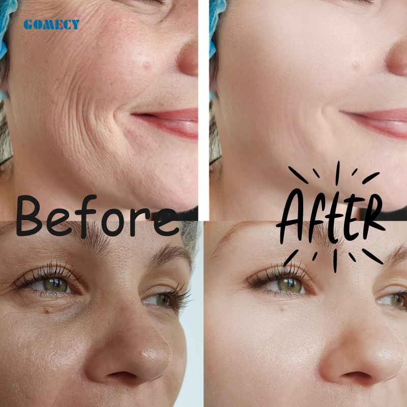 Facial Skin Firming Lifting Beauty Wholesale Wrinkle Remover Neck Lift Device