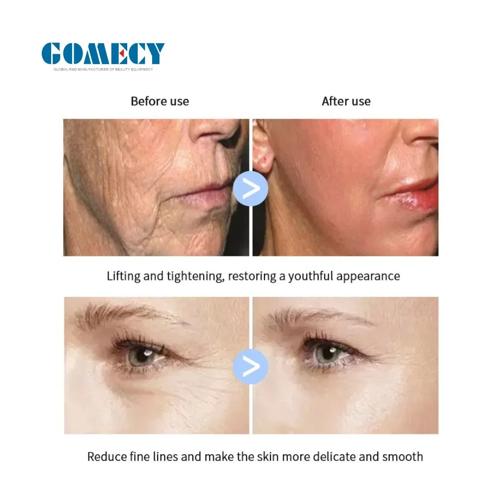 4th Generation Facial Radio Frequency Elite Ultrasound Product Exil Ultra 360 Machine RF Skin Tightening Machine Ultra 360