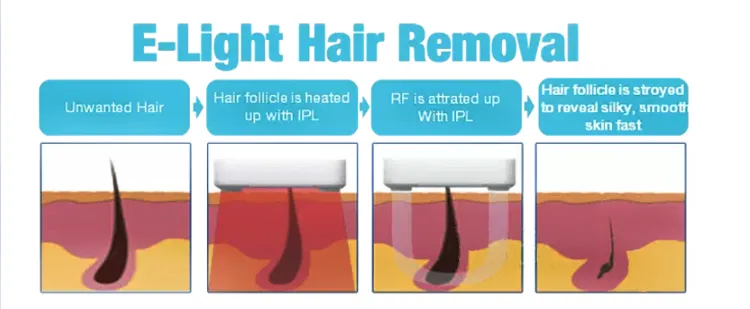 Laser Hair Removal