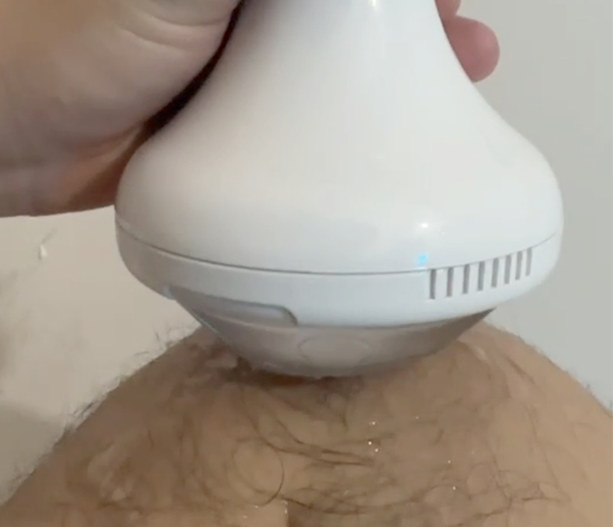 Pneumatic Focused Shockwave Therapy Plantar Fasciitis and Back Pain Management