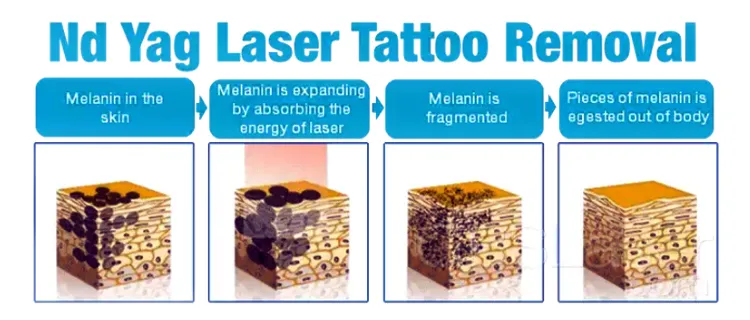 Laser Hair Removal