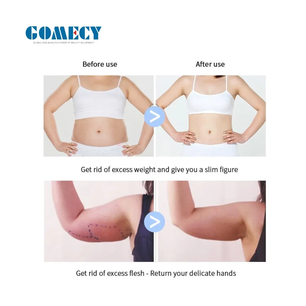 4th Generation Facial Radio Frequency Elite Ultrasound Product Exil Ultra 360 Machine RF Skin Tightening Machine Ultra 360