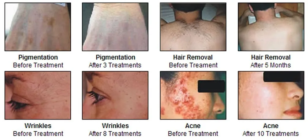 Application Treatment