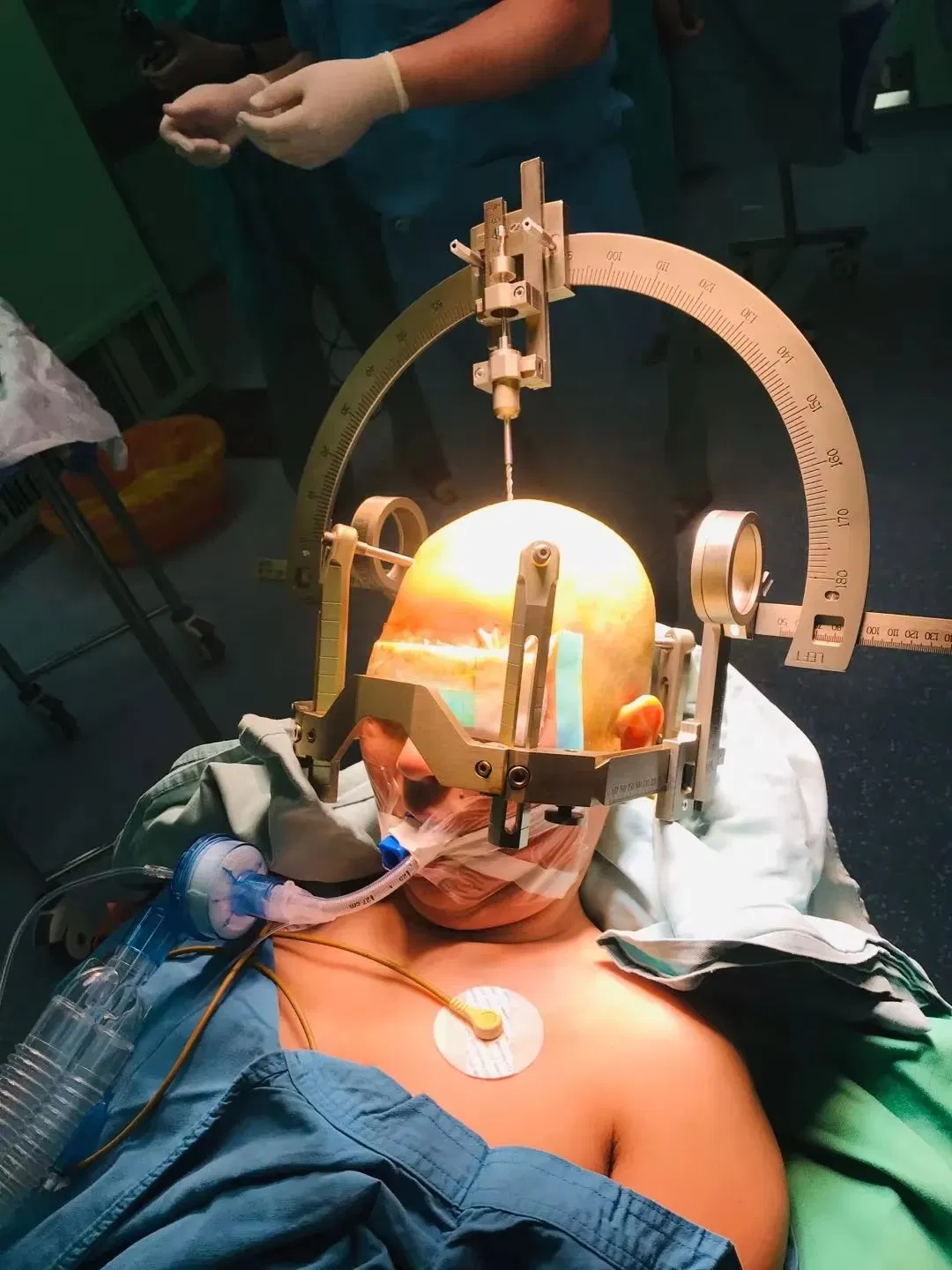 Sistema estereotáctico de marco de cabeza para estimulación cerebral profunda de alta precisión en neurocirugía