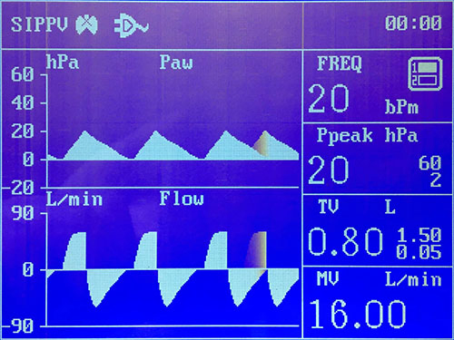 Un sistema de anestesia por vapor en la fábrica de suministros de UCI y emergencia para ventiladores hospitalarios