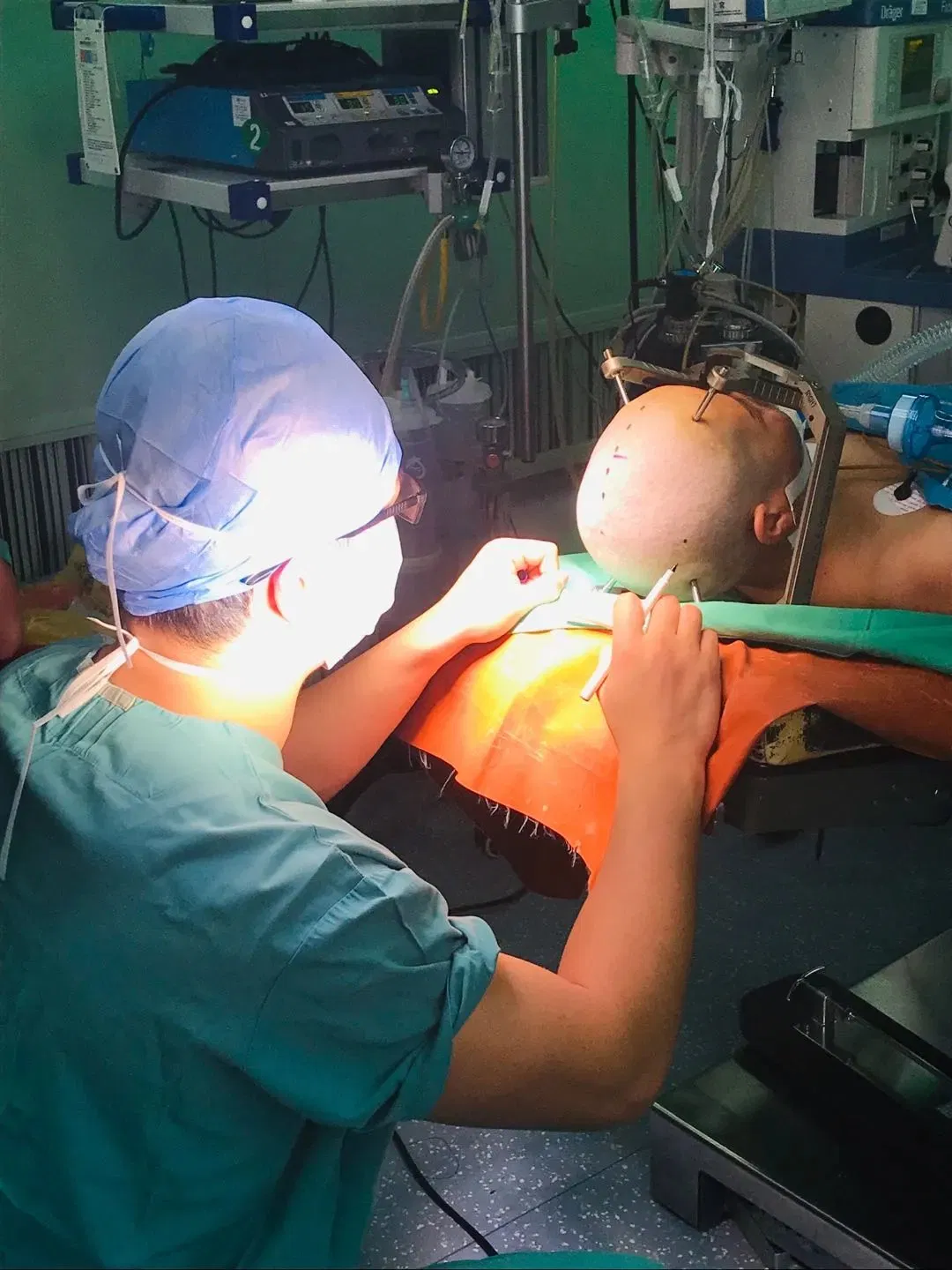 Sistema estereotáctico de marco de cabeza para estimulación cerebral profunda de alta precisión en neurocirugía