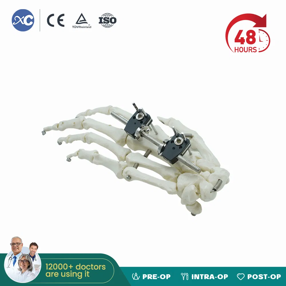 High Quality Mini Fragment External Fixator Orthopedic Medical Metacarpals External Fixation