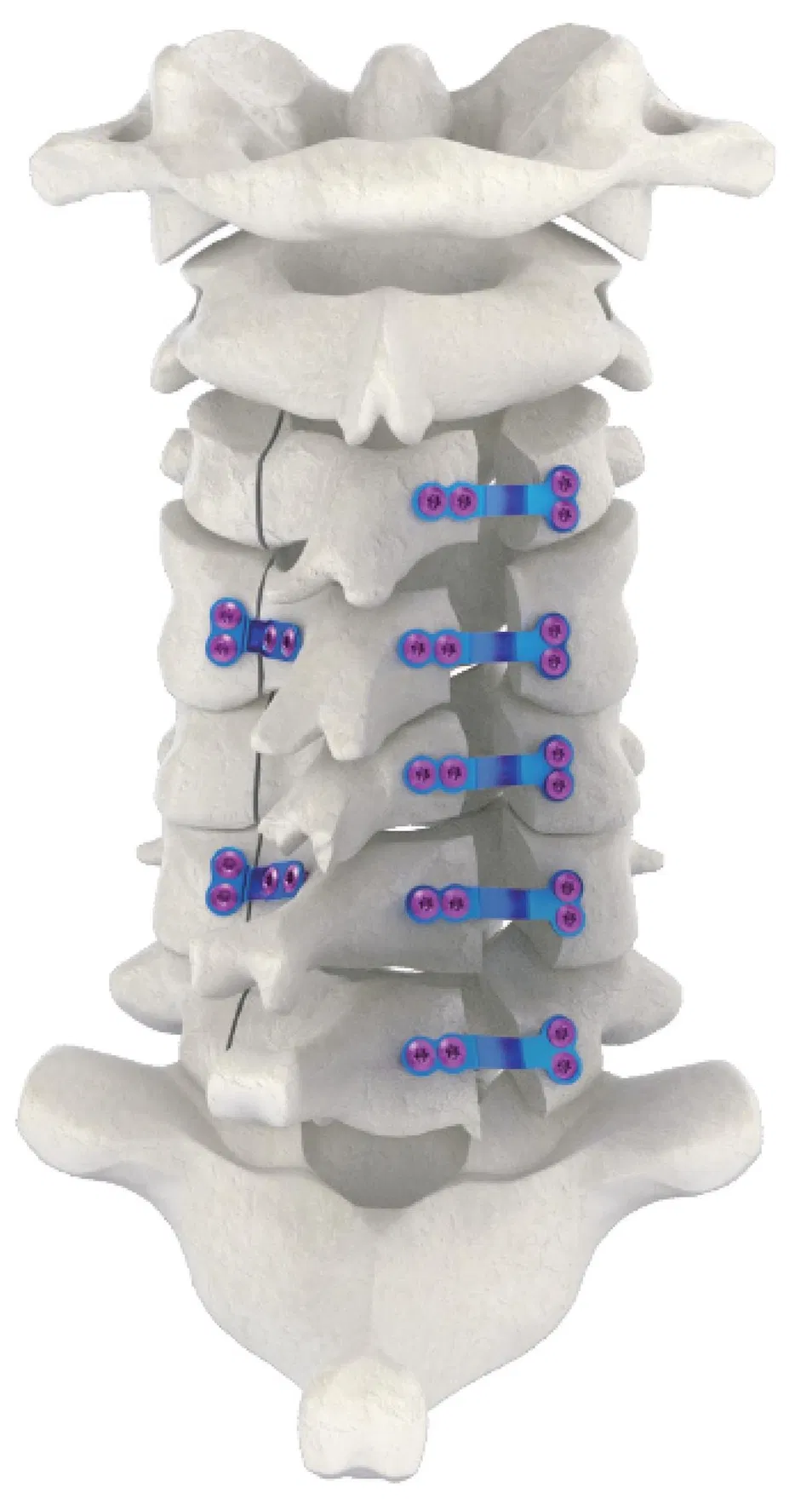 Posterior Cervical System