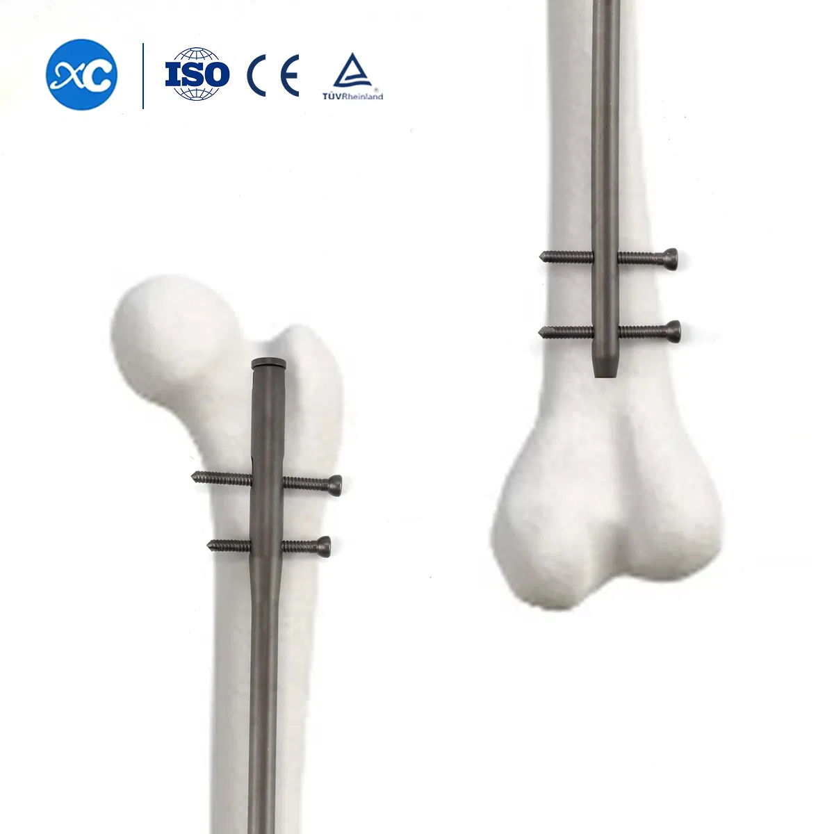 Lockable Intramedullary Nail Titanium Alloy