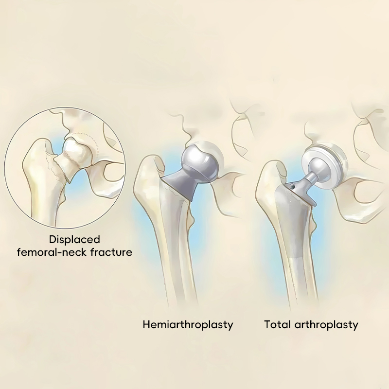 Titanium Cemented Femoral Stem Articulatio Coxae Reconstruction Total Hip Joint Replacement Prosthesis