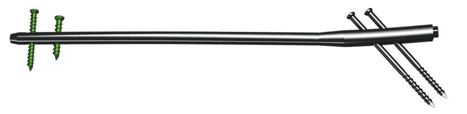 Titanium or Ss Femoral Intramedullary Nails