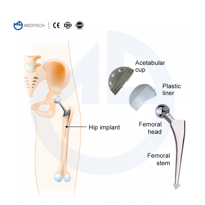 Hip Artificial Knee Joint Orthopedic Implants Cemented Stem Hip Replacement