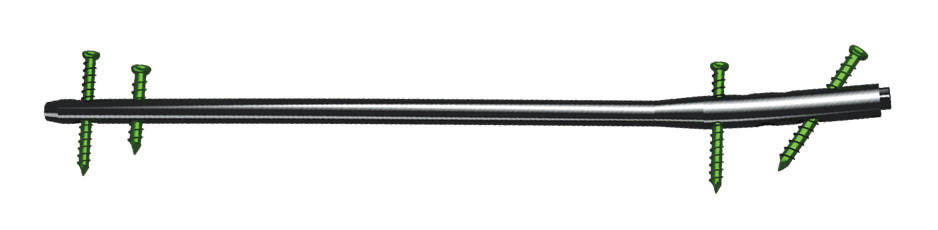 Titanium or Ss Femoral Intramedullary Nails