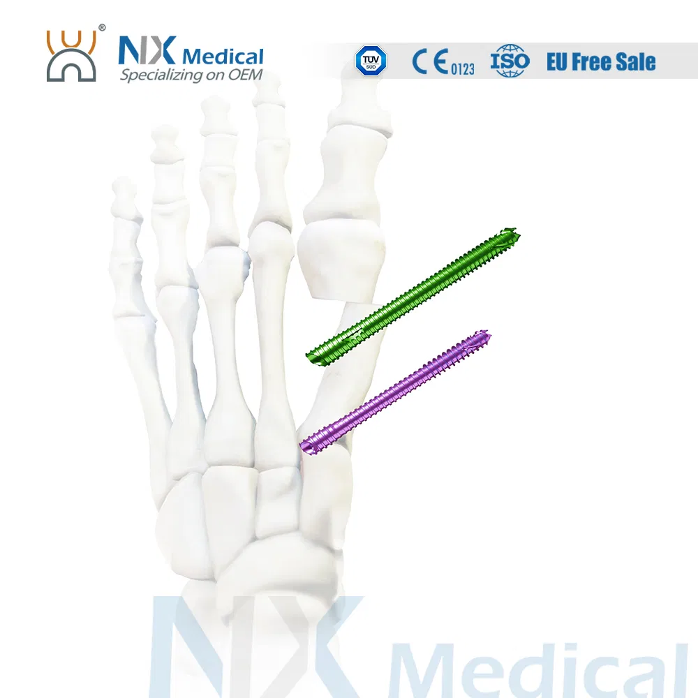 Nx Medical Cannulated Beleved Bunionectomy Screws Minimum Invasive