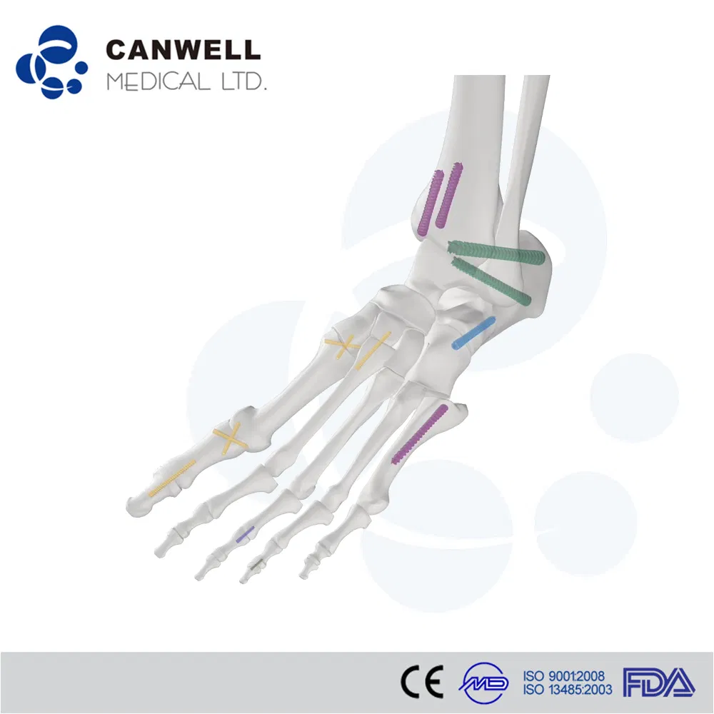 Orthopedic Compression Screws Detail