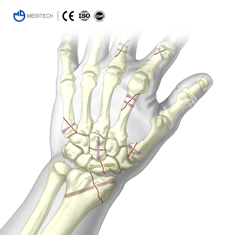 Titanium Medical Bone Screws Herbert Cannulated Compression Screw Price