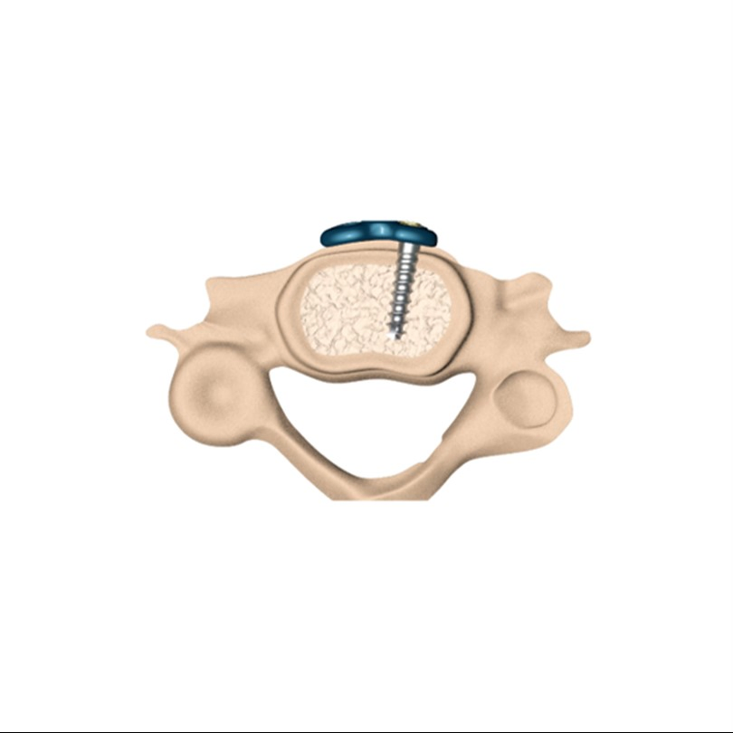 Spine Fixation Anterior Cervical Plate System