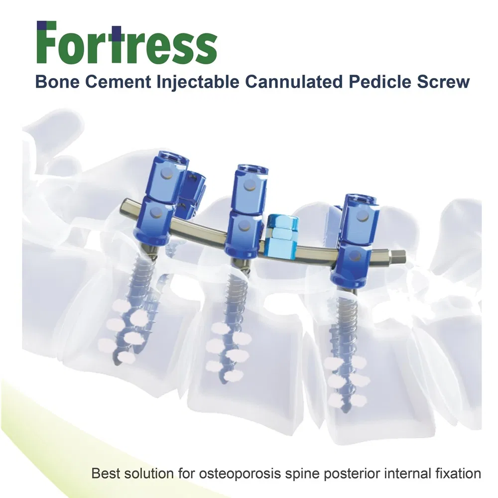 Bone Cement Pedicle Screw 1