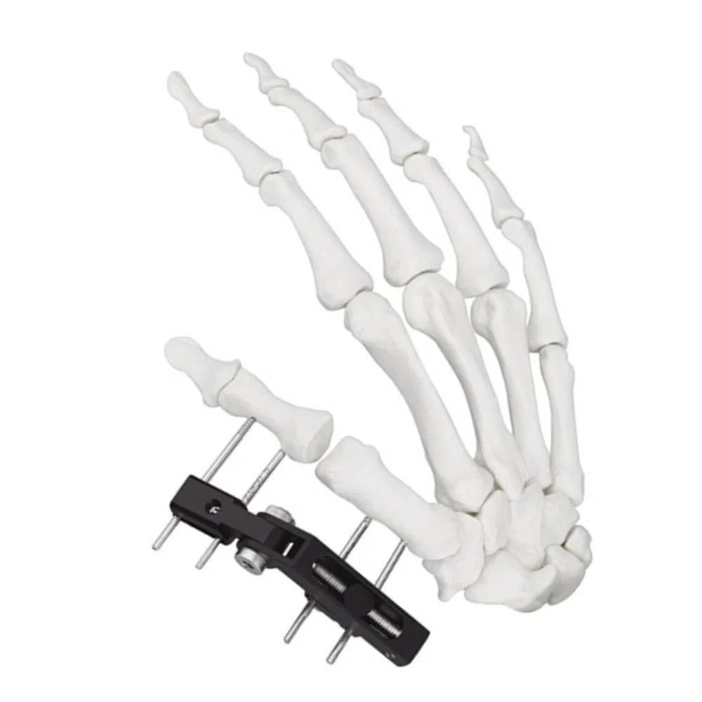 External Fixator Hand Bone Pin Stent Radius Mini Fixator Track Vertical Axis Type