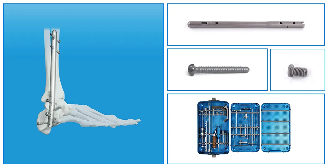 Ankle Fusion Nail Components