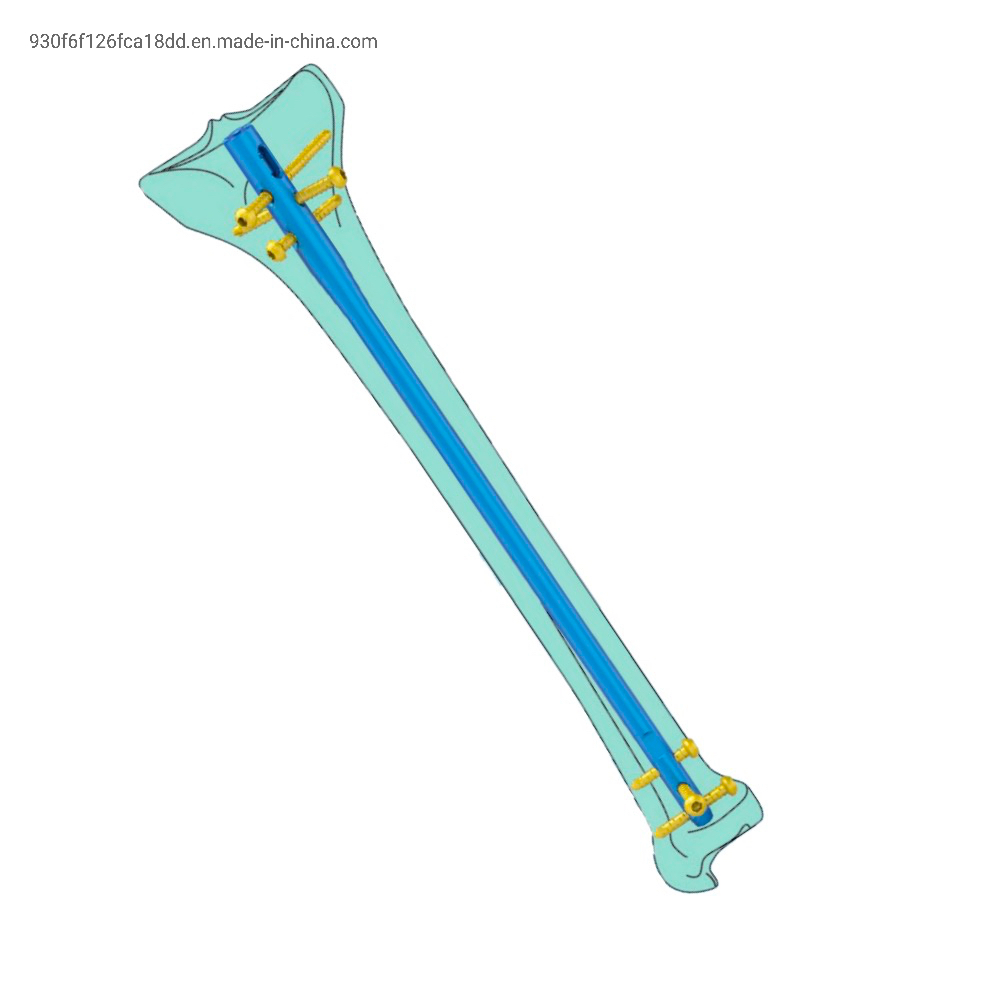 Intramedullary Nail System Expert Tibial Interlocking Nail Suprapatellar Approach