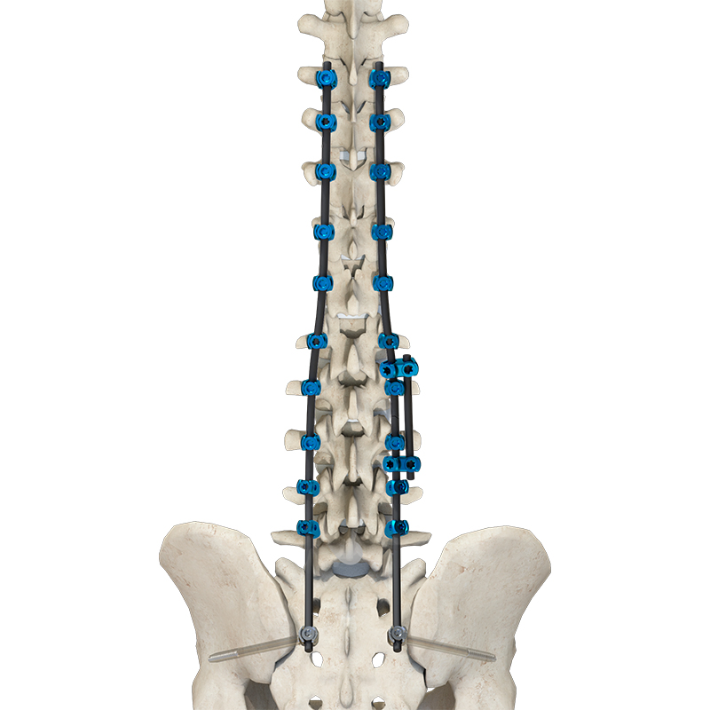 Ultra-Resilient Internal Fixation Hook for Spinal Surgery Solutions