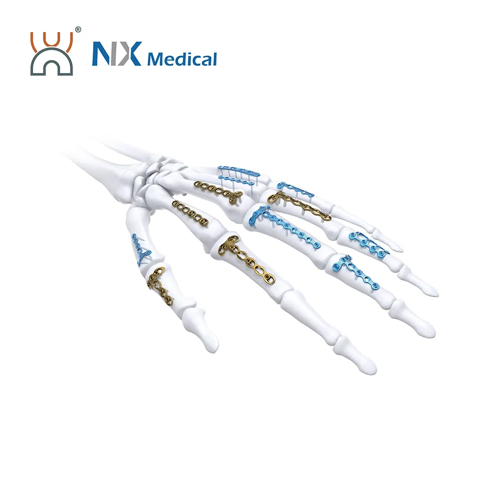 Nx Medical Variable Angle Super Orthopedic Locking Plate Bone Fixation Plate