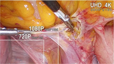 Surgical Camera System