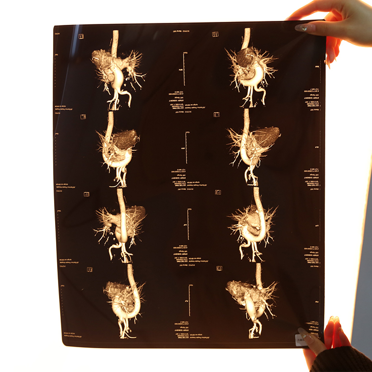 Shenmu High Density Fast-Processing Medical Dry Imaging Film