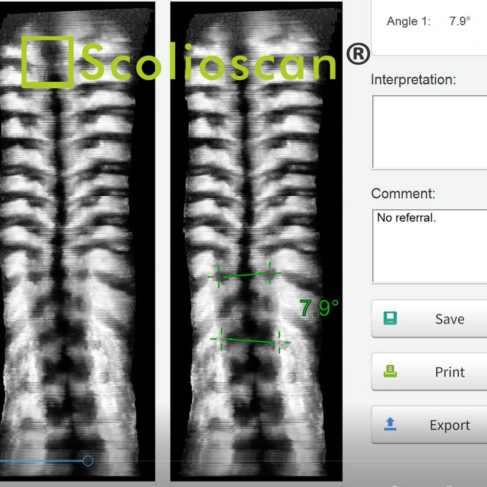 Cobb Angle Measurement Ultrasound Imaging Scanner SCN201 Thoracolumbar Scoliosis Assessment System AI Automated Software