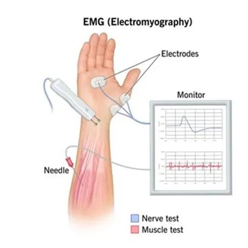 Electromyography Components