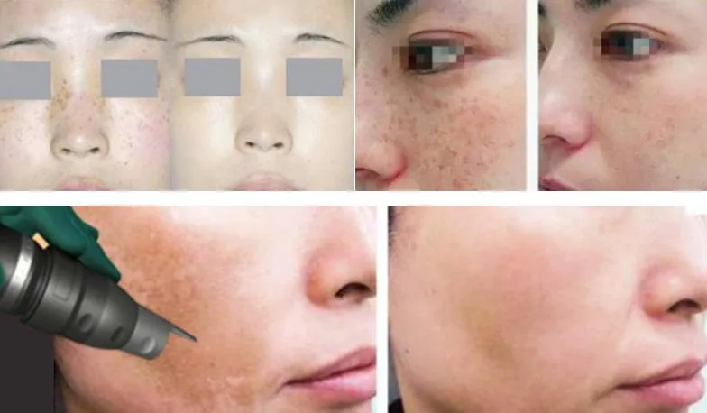 Before and After Results