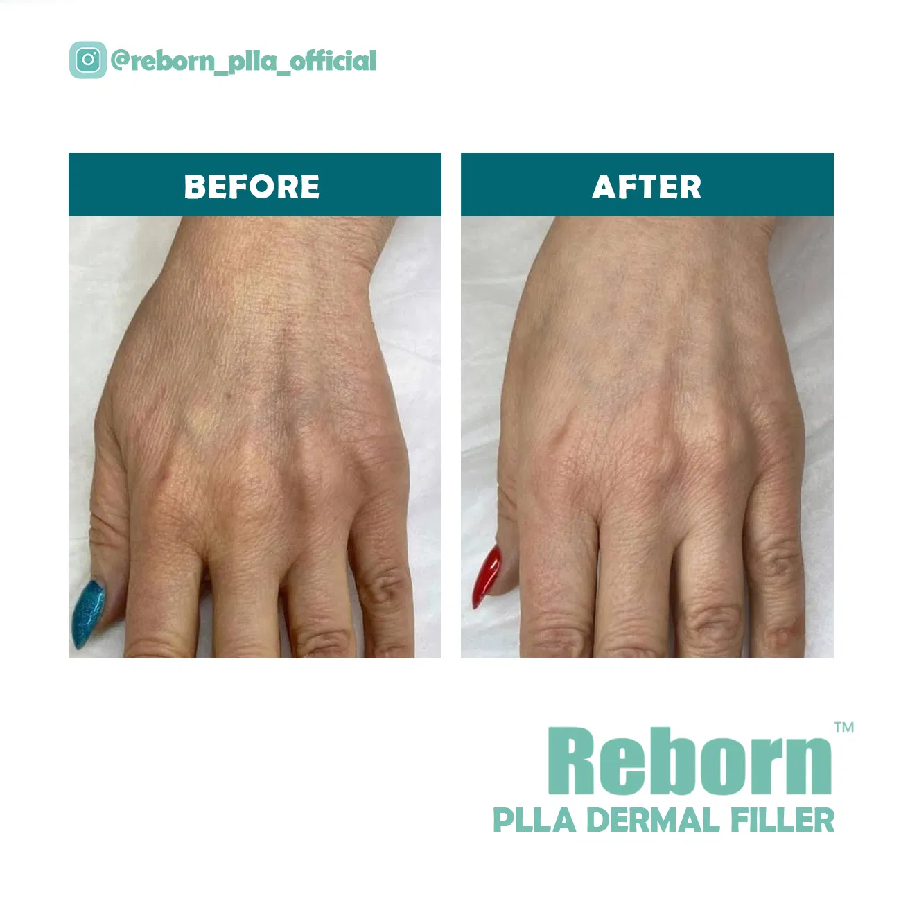 Best Price Cosmetics Aesthetics Plla Liquid Dermal Filler for Nonsurgical Plastic Surgery Injection Face Beauty Care