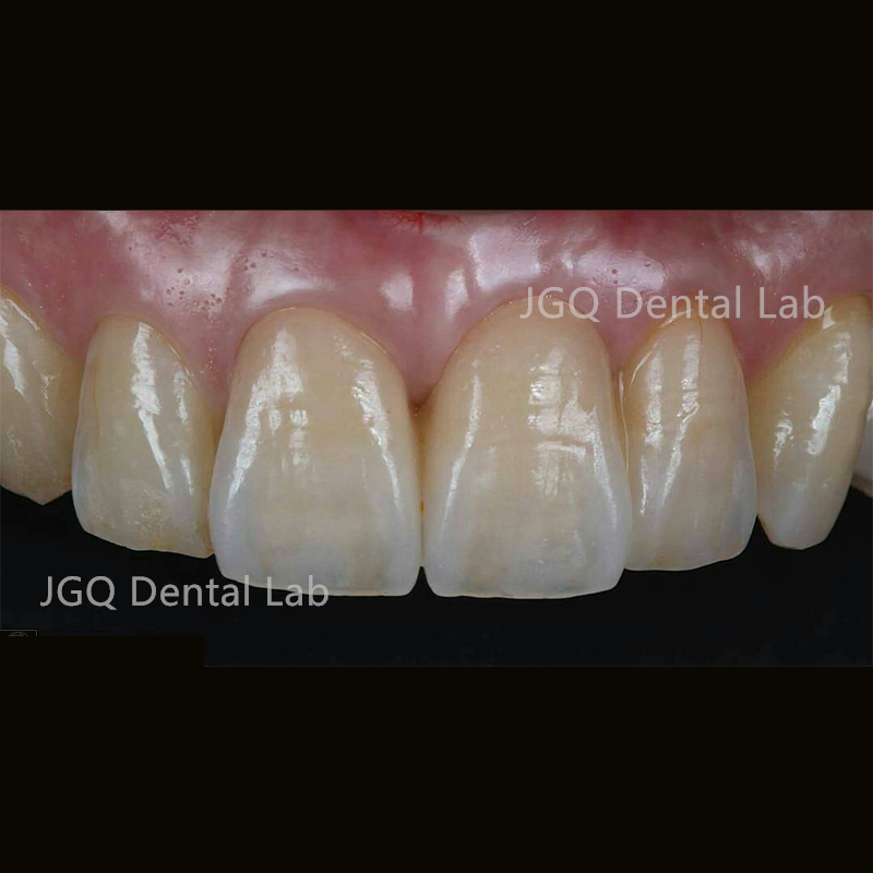 International Standard Monolithic Zirconia Crowns Chinese Dental Lab with High Aesthetic Quality for Oral Recovery