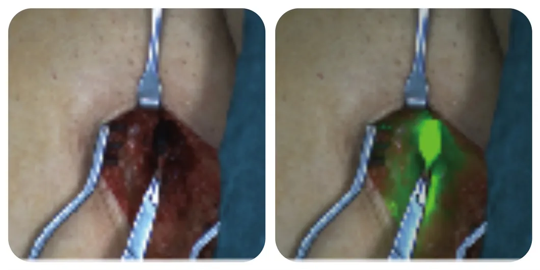 Lower limb lymphatic mapping